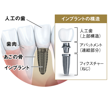 インプラント
