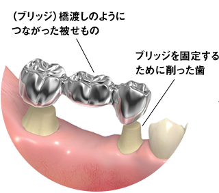 ブリッジ