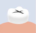 虫歯